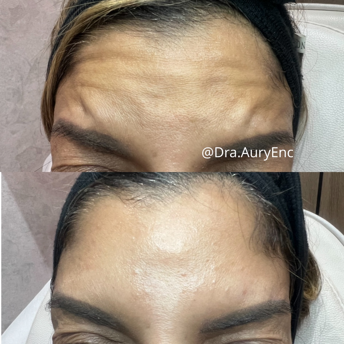 Botox