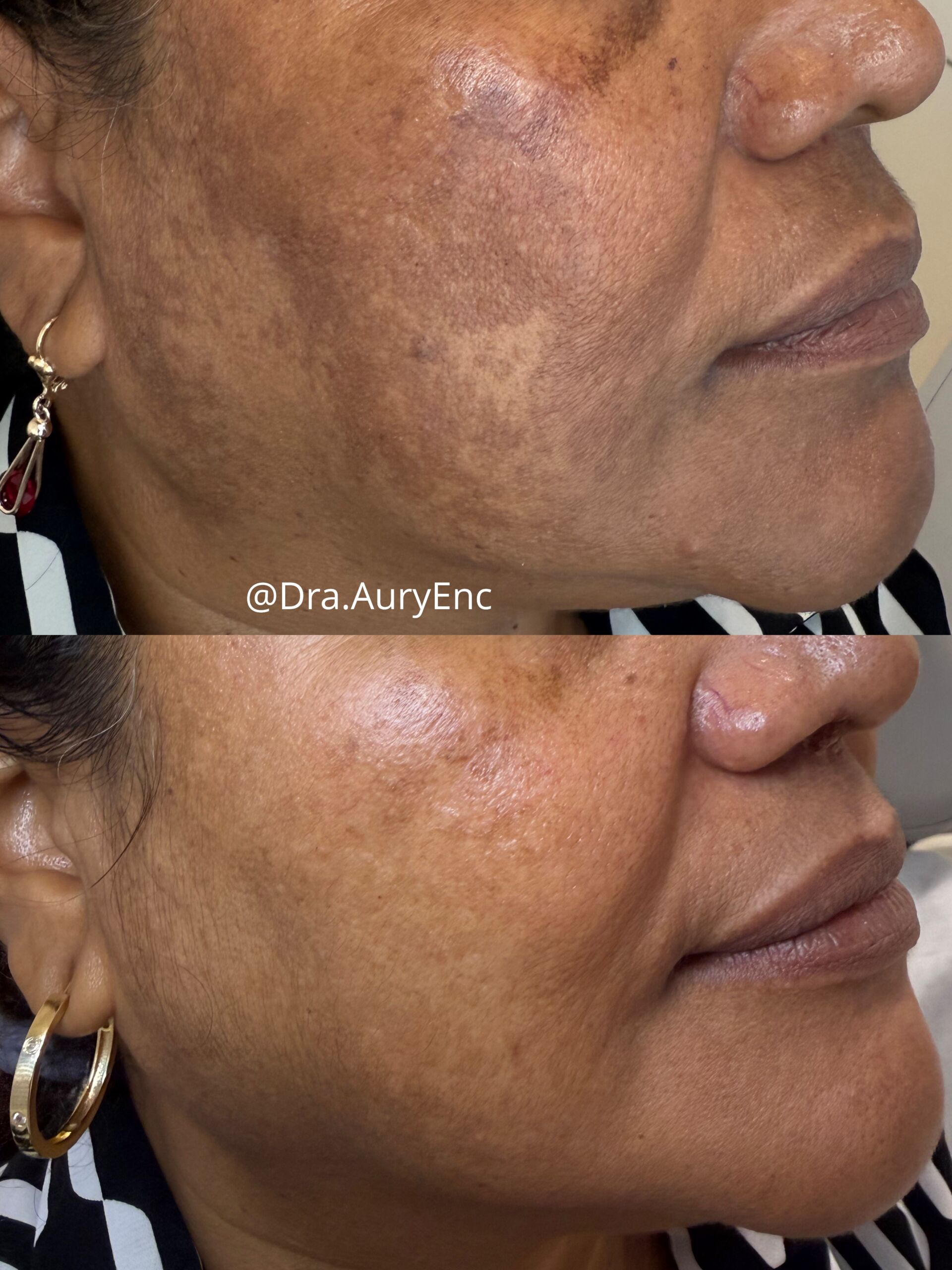 Melasma