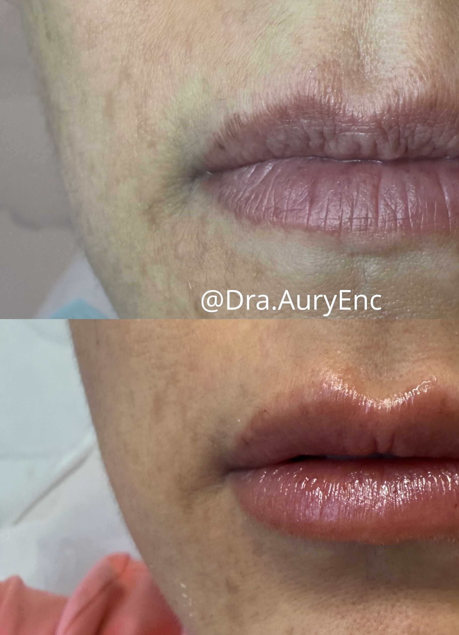 Relleno de Labios