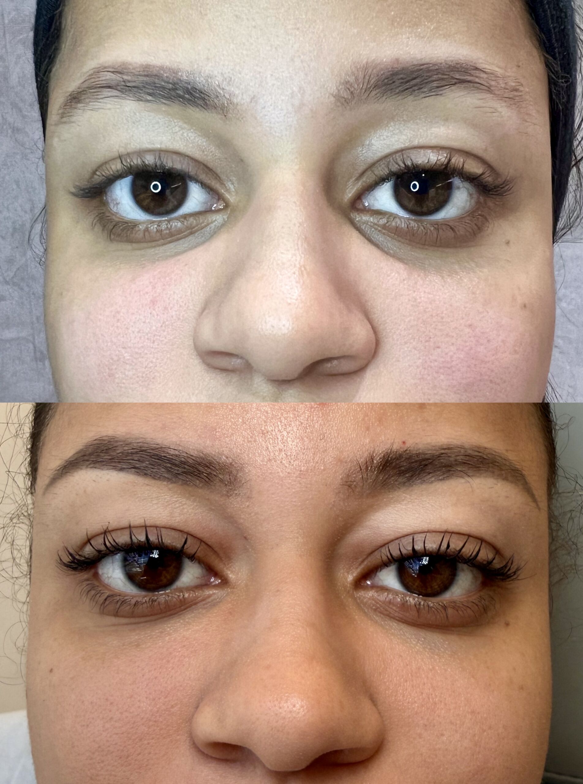 Relleno de Ojeras